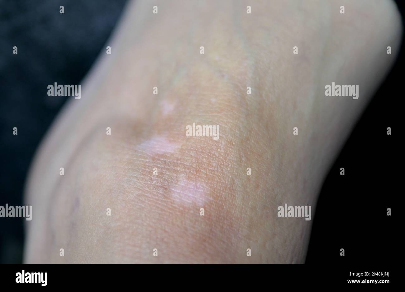 Close-up of several fading white vitiligo skin patches on the left foot ankle of a Caucasian female Stock Photo