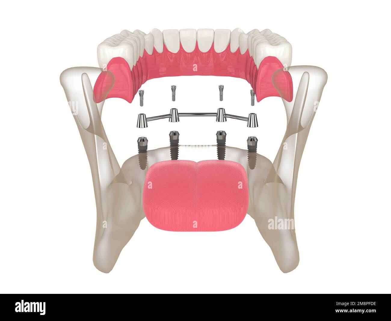 3d render of bar retained removable overdenture installation supported by four implants over