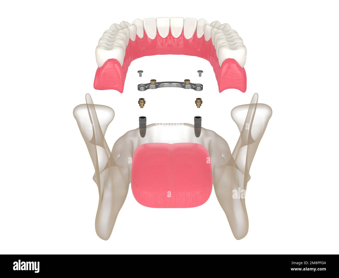 3d render of bar retained removable overdenture installation supported by two implants over