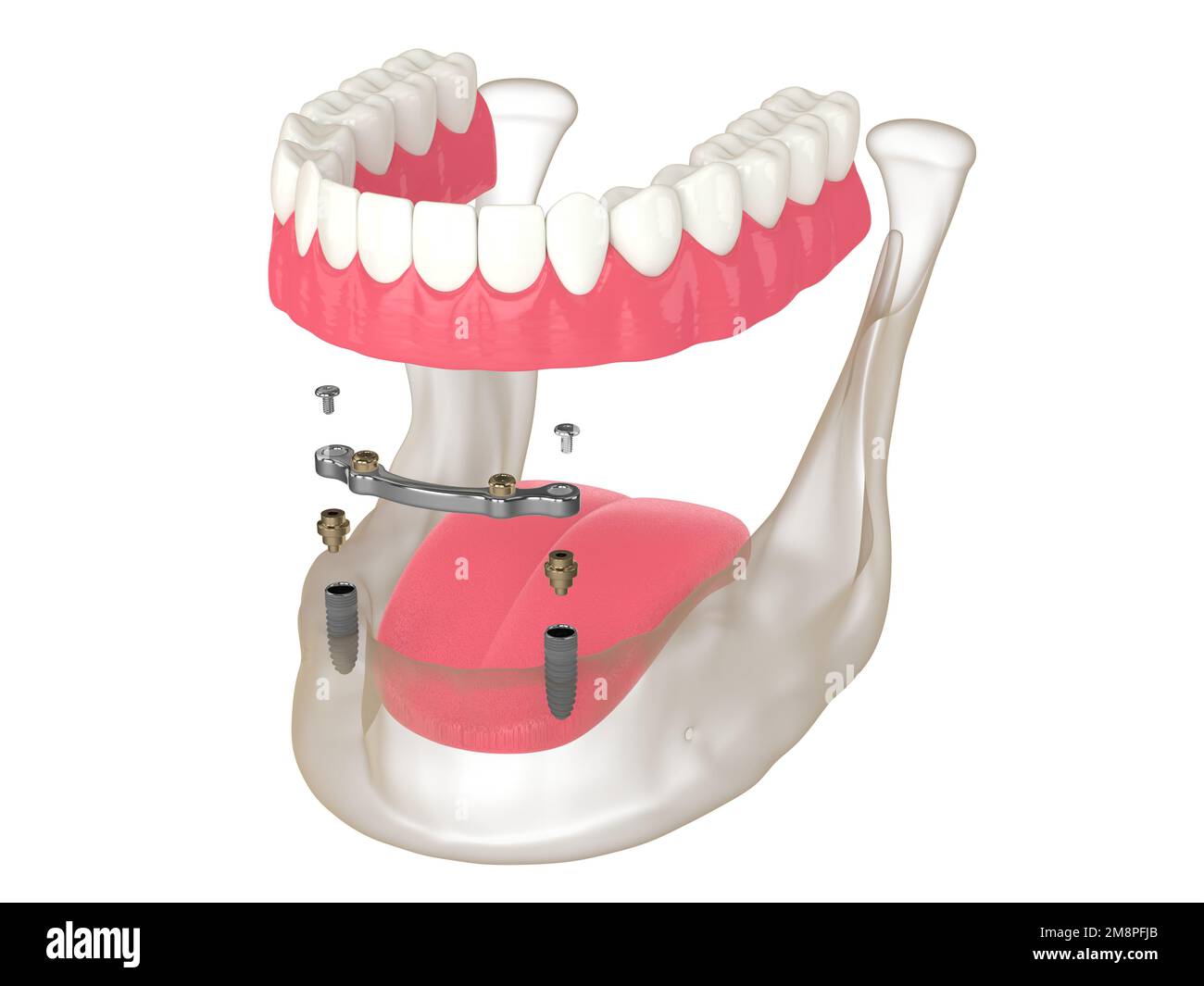 3d render of bar retained removable overdenture installation supported by two implants over