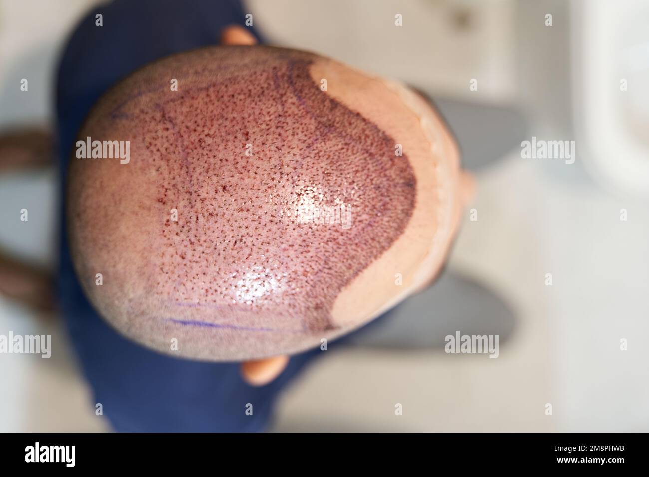 Top view of scalp after hair transplant surgery Stock Photo Alamy