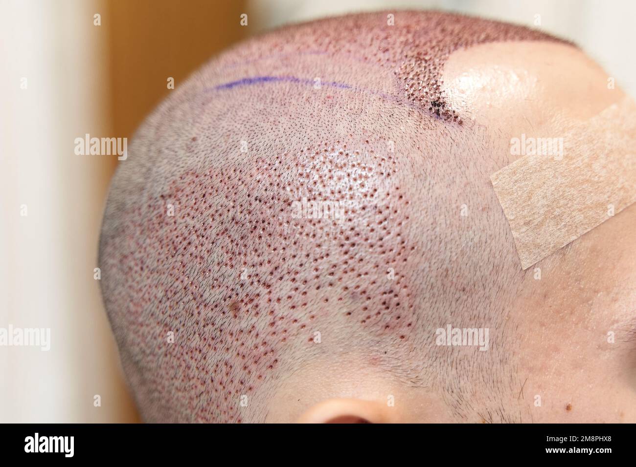 Baldness cure. Treatment for hair loss. Side view of male scalp after hair transplant surgery Stock Photo
