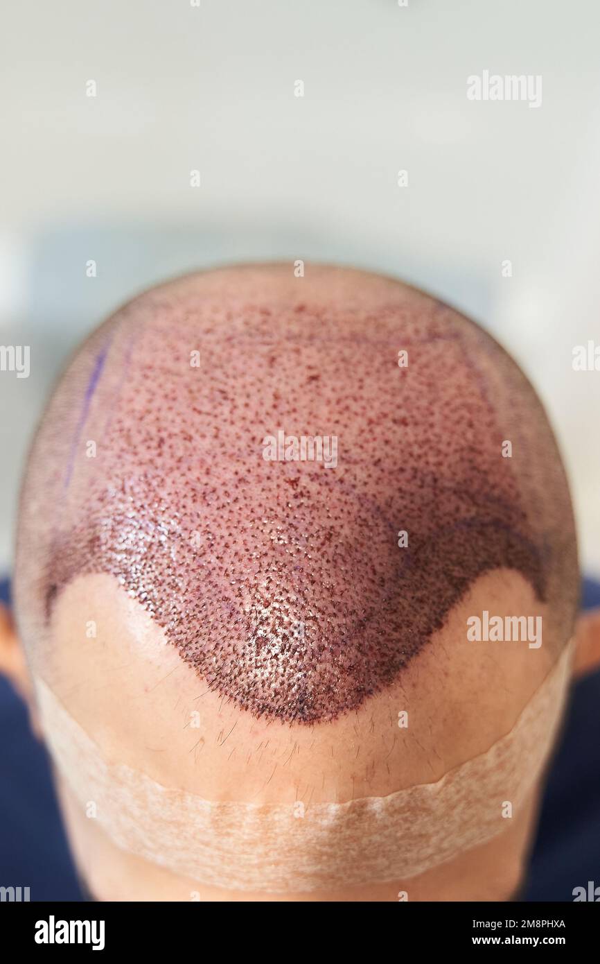 Vertical shot of hair line on male scalp after hair transplant surgery Stock Photo