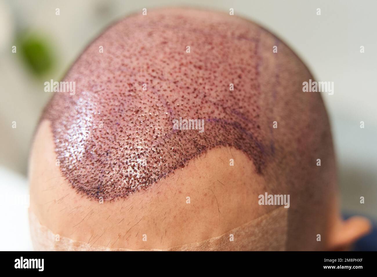 Detail of hair line after hair transplant surgery to cure baldness at clinic Stock Photo