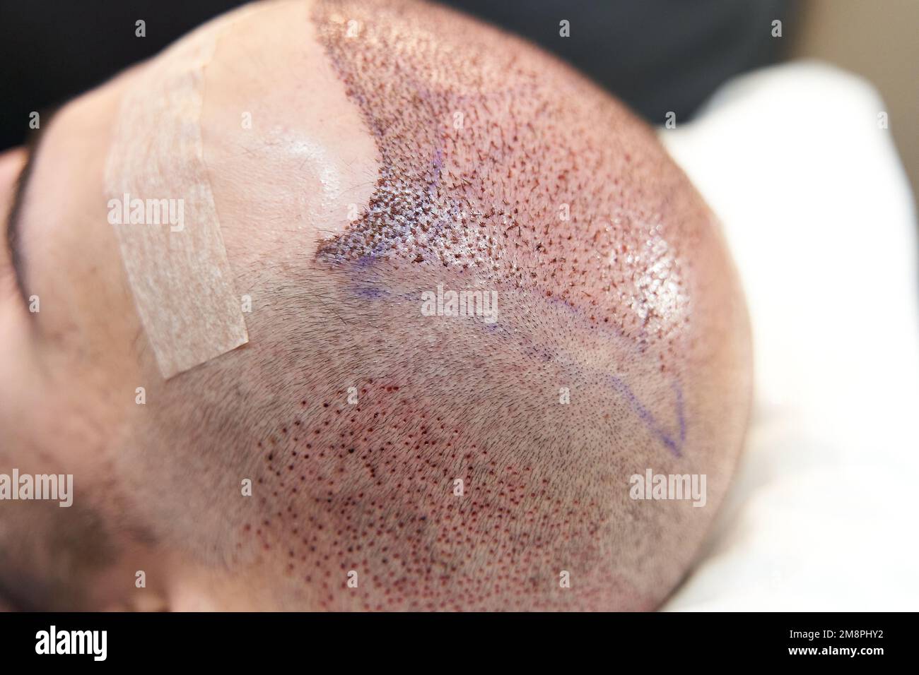 Side view of male head after hair transplant surgery Stock Photo