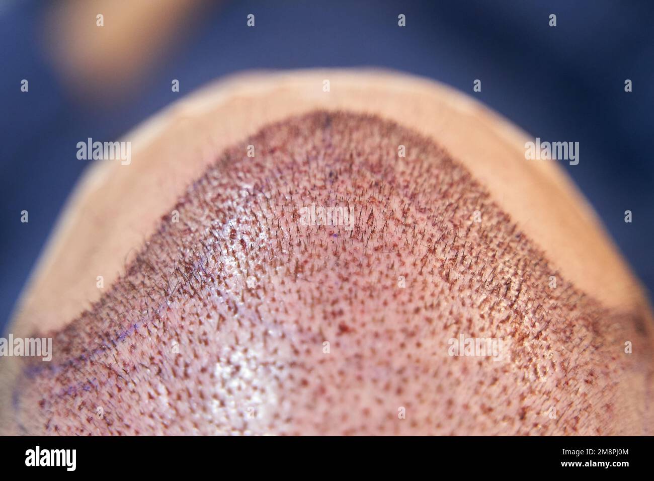 Detail of new hair line after hair transplant procedure Stock Photo