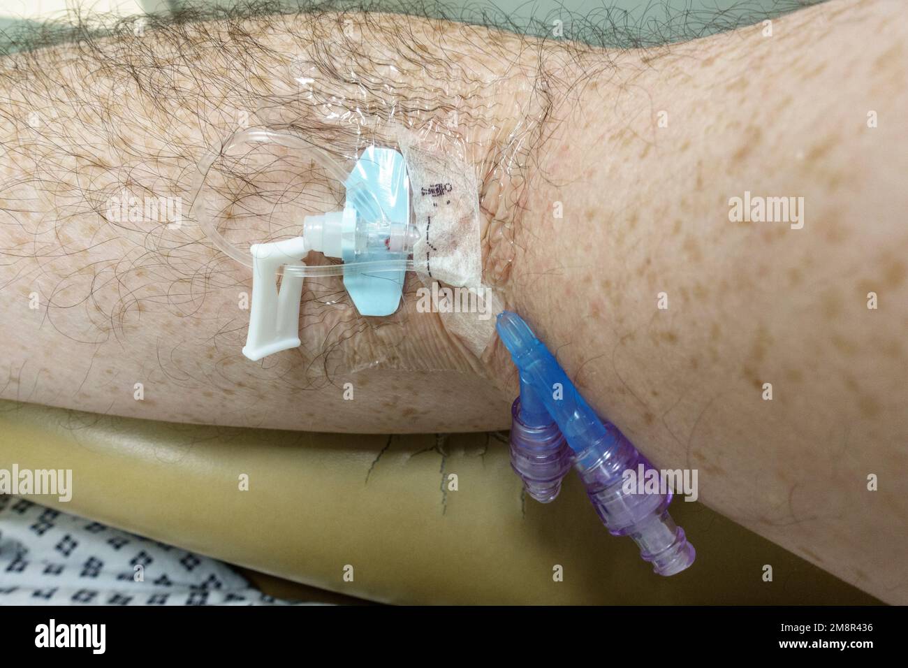 Patients view of a medical cannula placed into a vein in his right arm prior to sedation in a UK NHS hospital (Dec 2022).. Stock Photo