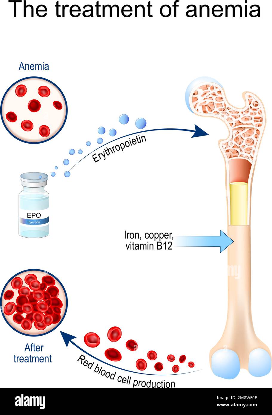 Erythropoietin and treatment of anemia. Glycoprotein cytokine that stimulates red blood cell production. erythropoiesis. Vial with EPO. anemia Stock Vector