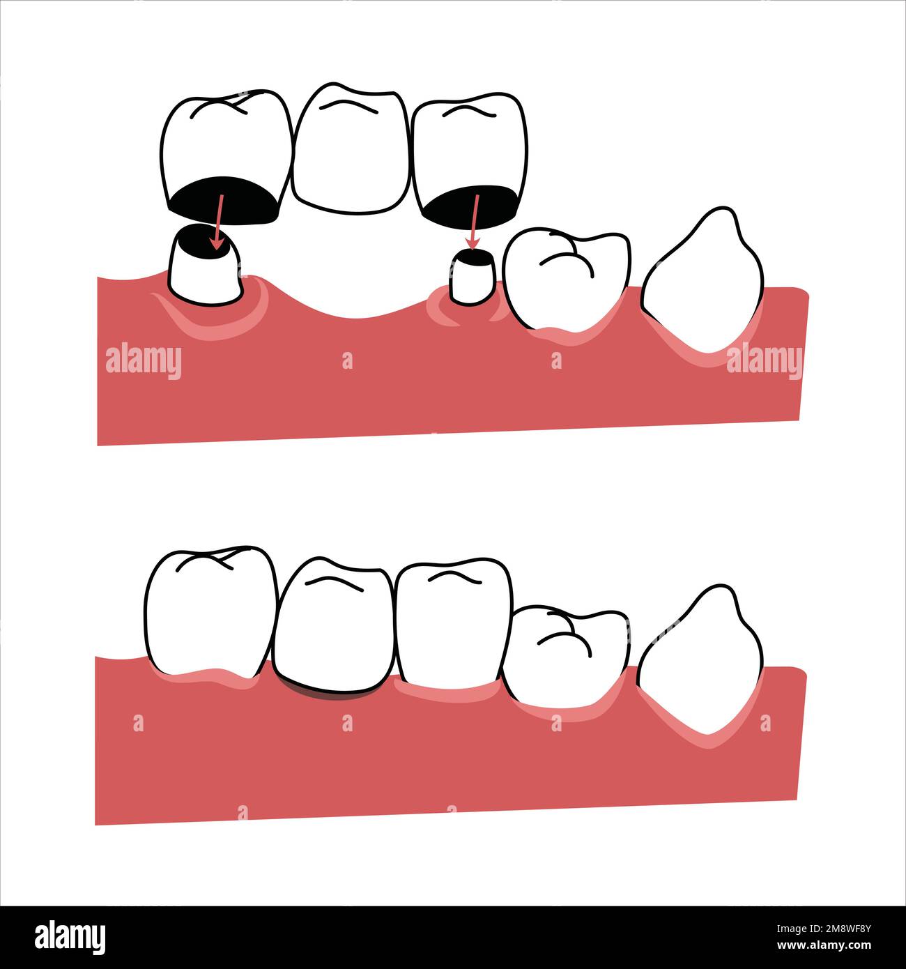 Flat informational graphic of dental bridge installation. Human anatomy scientific illustration for educational or advertising use Stock Vector