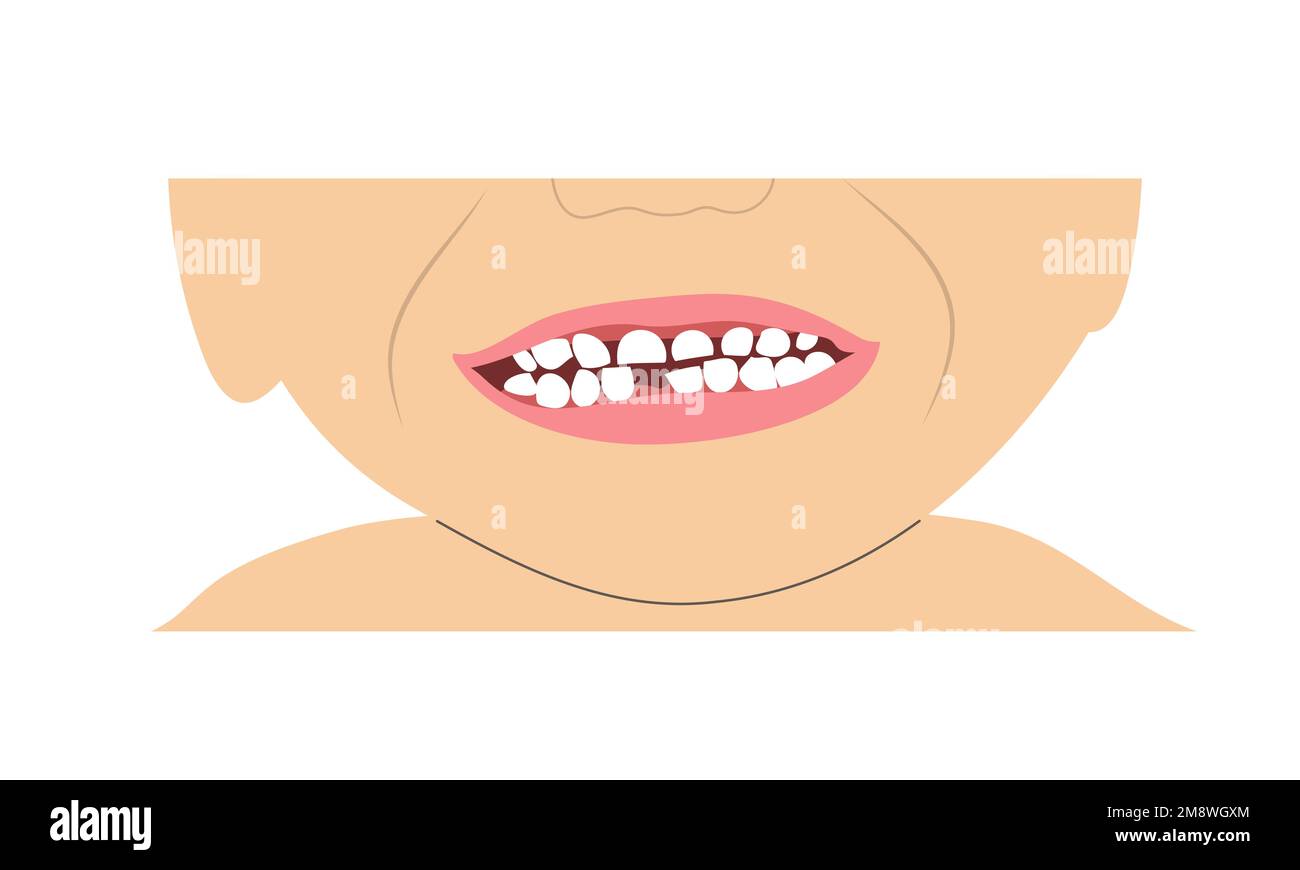 Little boy smile missing tooth due to change of milk teeth. Simple minimalistic illustration of baby mouth with incomplete set of teeth. Stock Vector