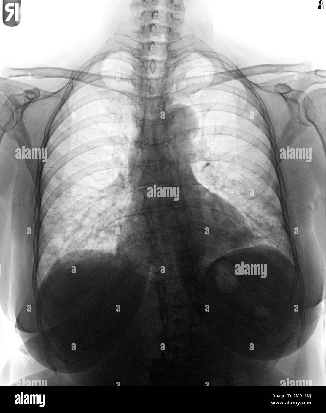 Film chest x-ray of normal woman chest Stock Photo - Alamy
