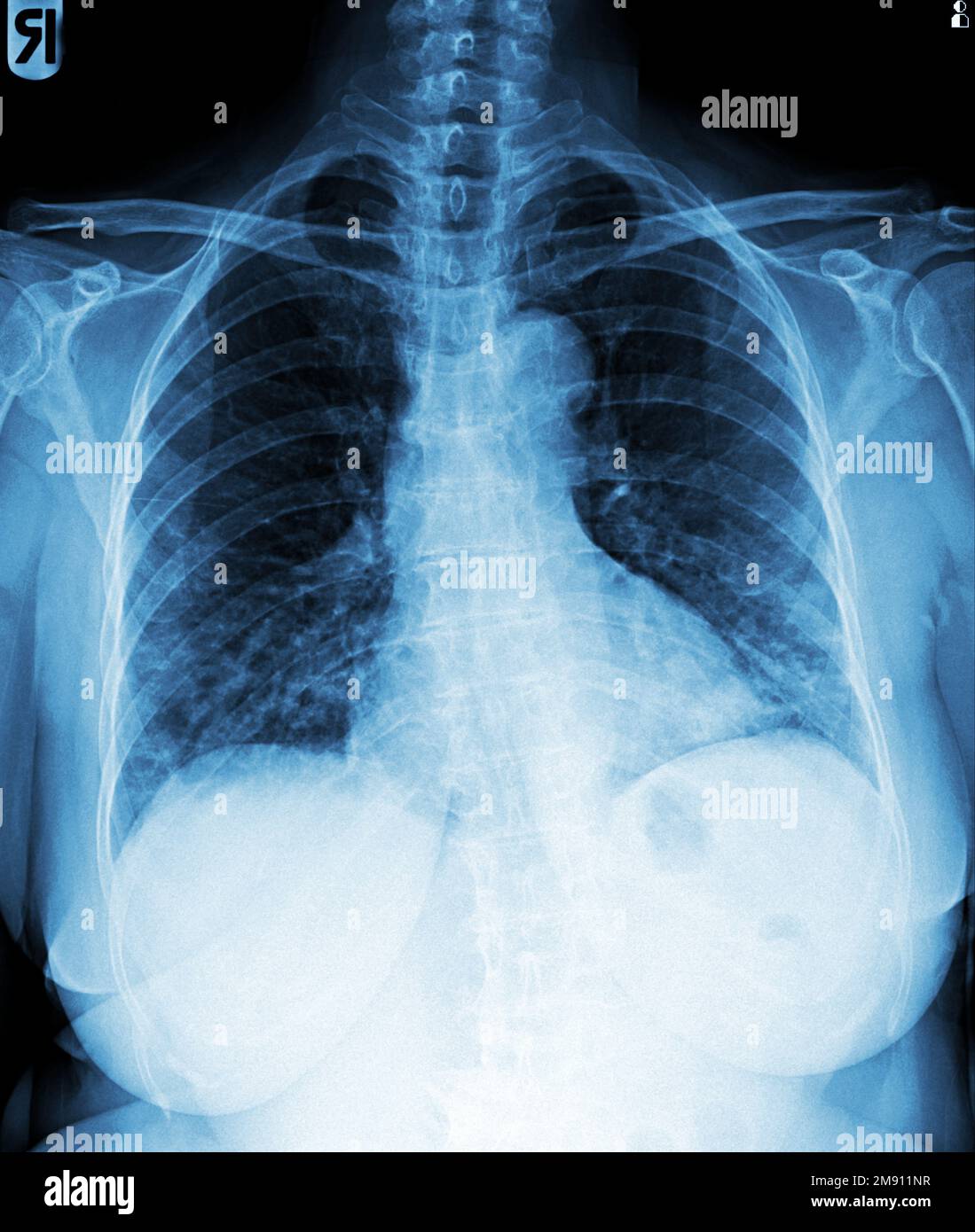 Film chest xray of normal woman chest Stock Photo Alamy