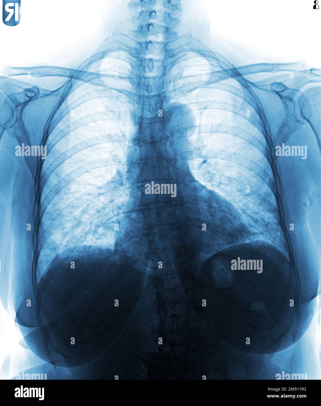 Film chest xray of normal woman chest Stock Photo Alamy
