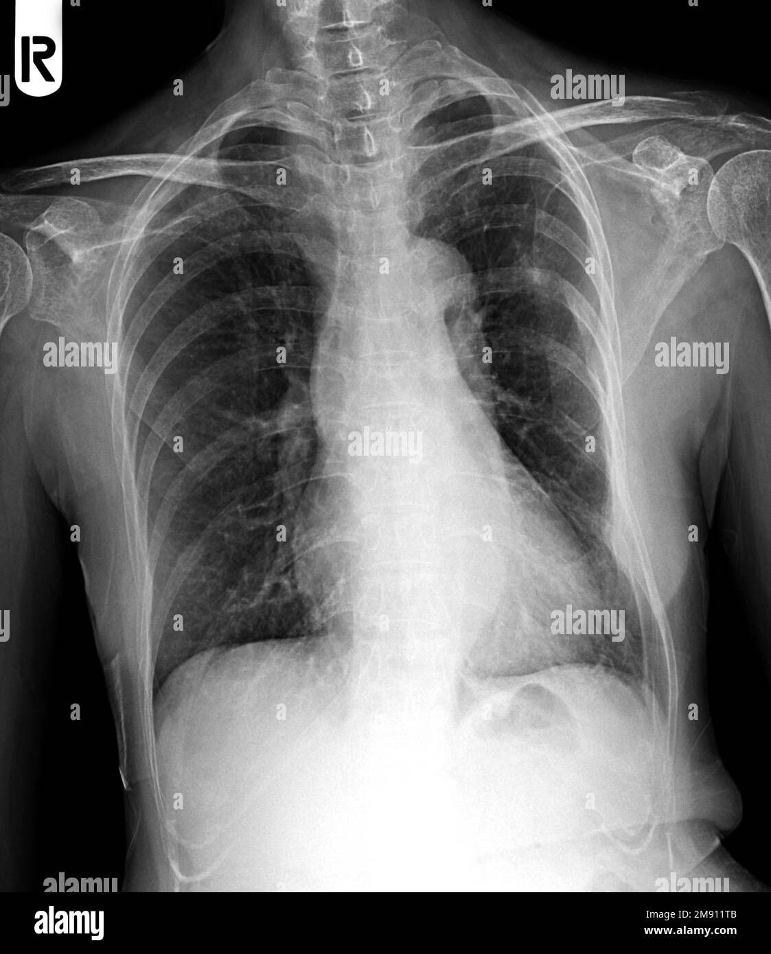 Pulmonary tuberculosis tb chest x ray hires stock photography and