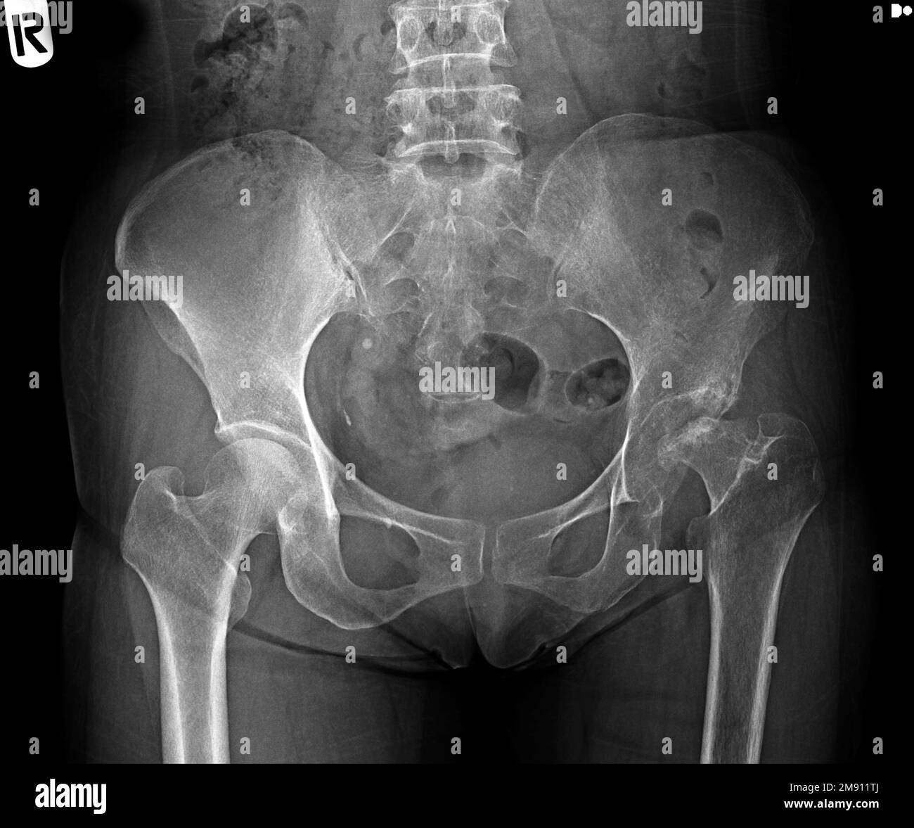 Film x-ray of human pelvis and hip joints Stock Photo