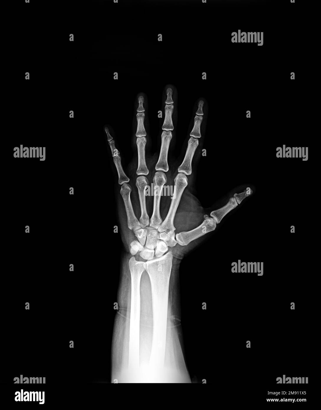 X-ray hand AP view normal Stock Photo