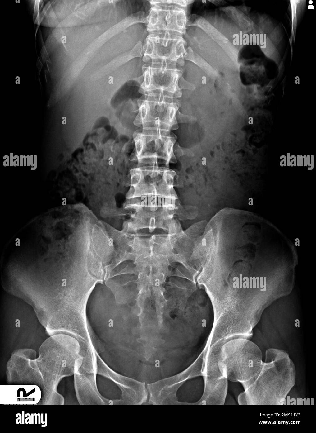 Abdomen, X ray abdomen Stock Photo Alamy