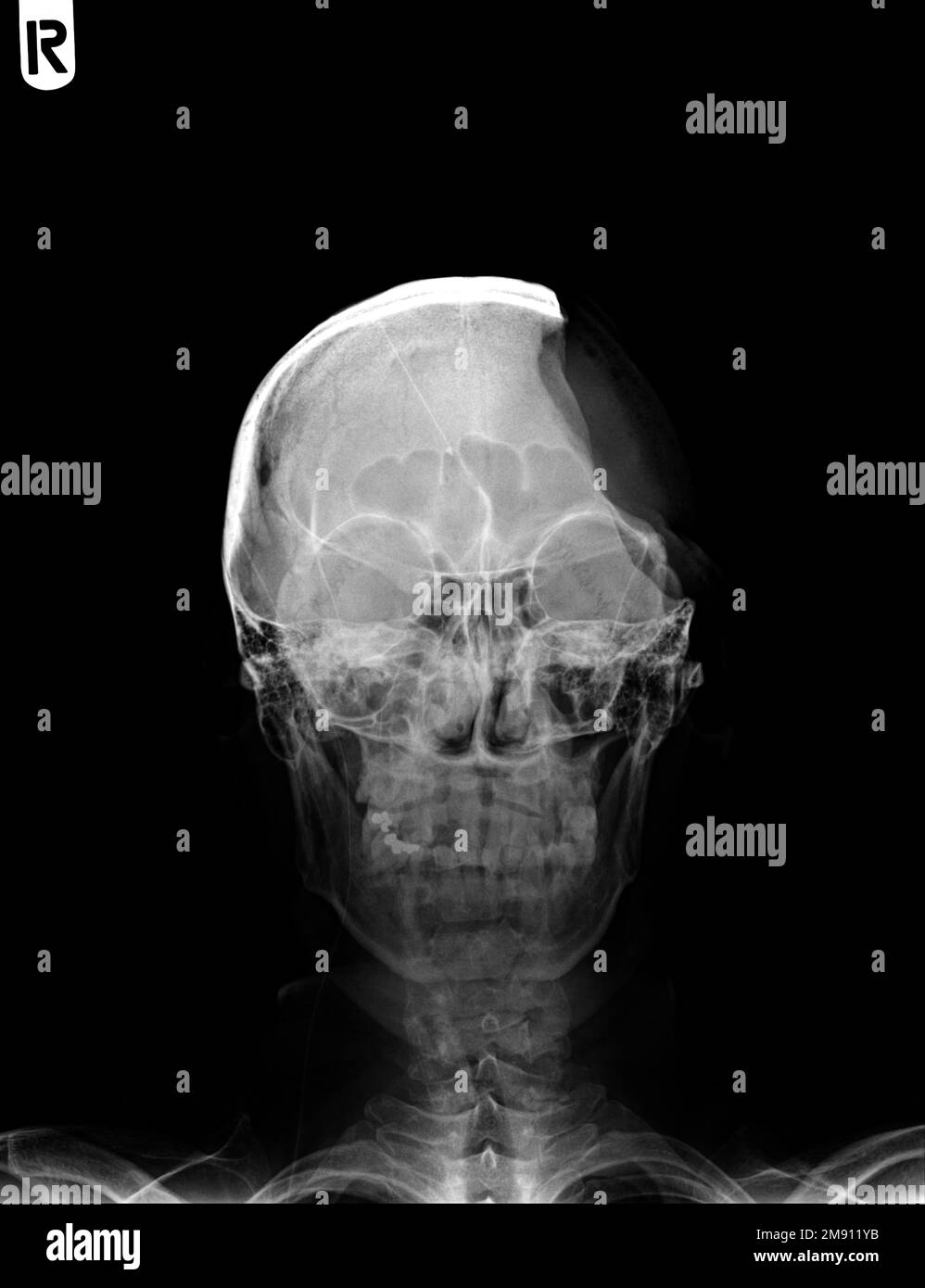 Headache of trauma. Film x-ray human skull . front view . Stock Photo