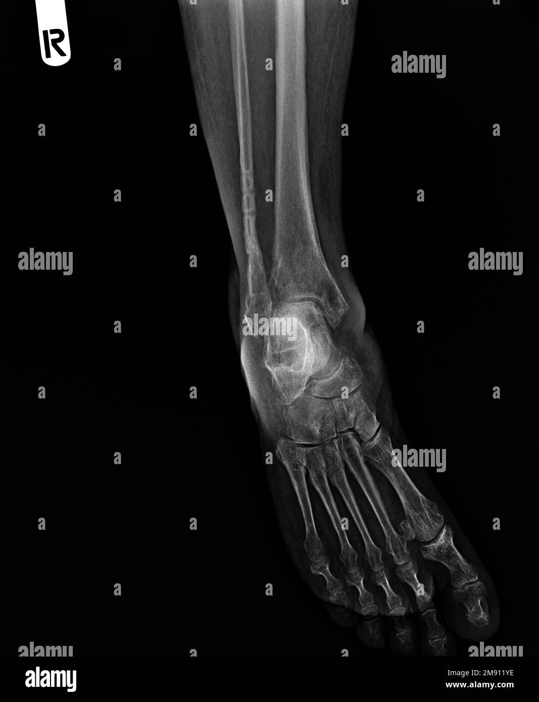 film x ray fracture of broken ankle Stock Photo