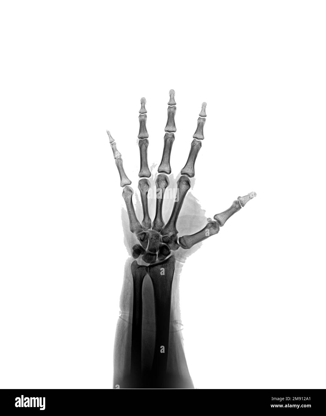 X-ray hand AP view normal Stock Photo