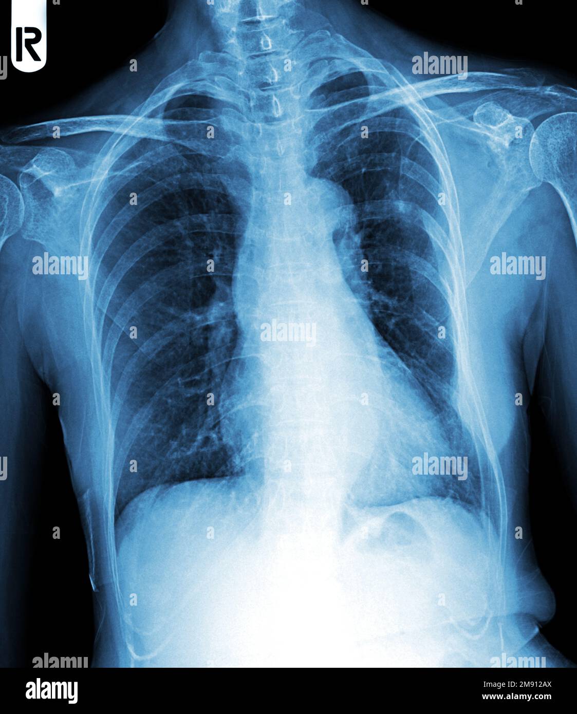 Film chest x-ray show interstitial infiltration both lung Stock Photo