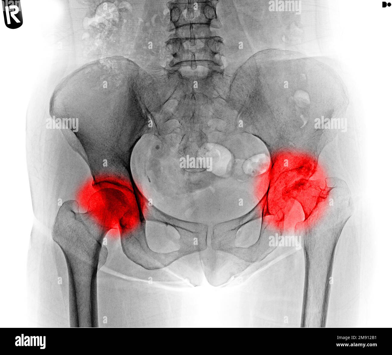 Film x-ray of human pelvis and facture hip joints in red area Stock Photo