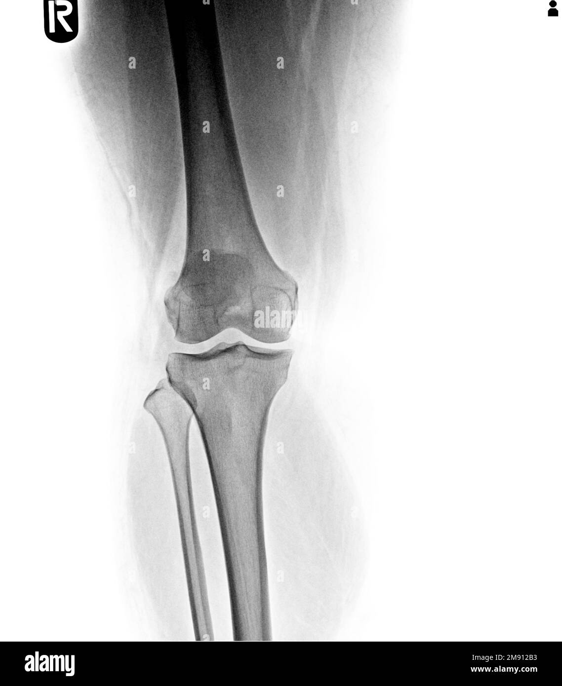 film x-ray AP ( anterior - posterior ) of knee show narrow joint space ...