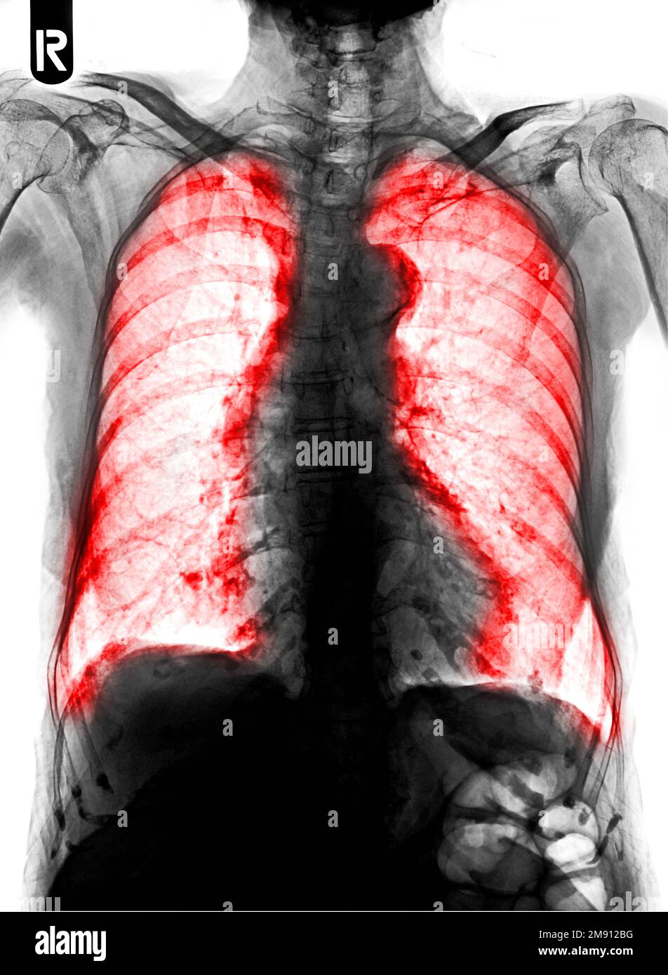 Film chest xray show interstitial infiltration both lung Stock Photo