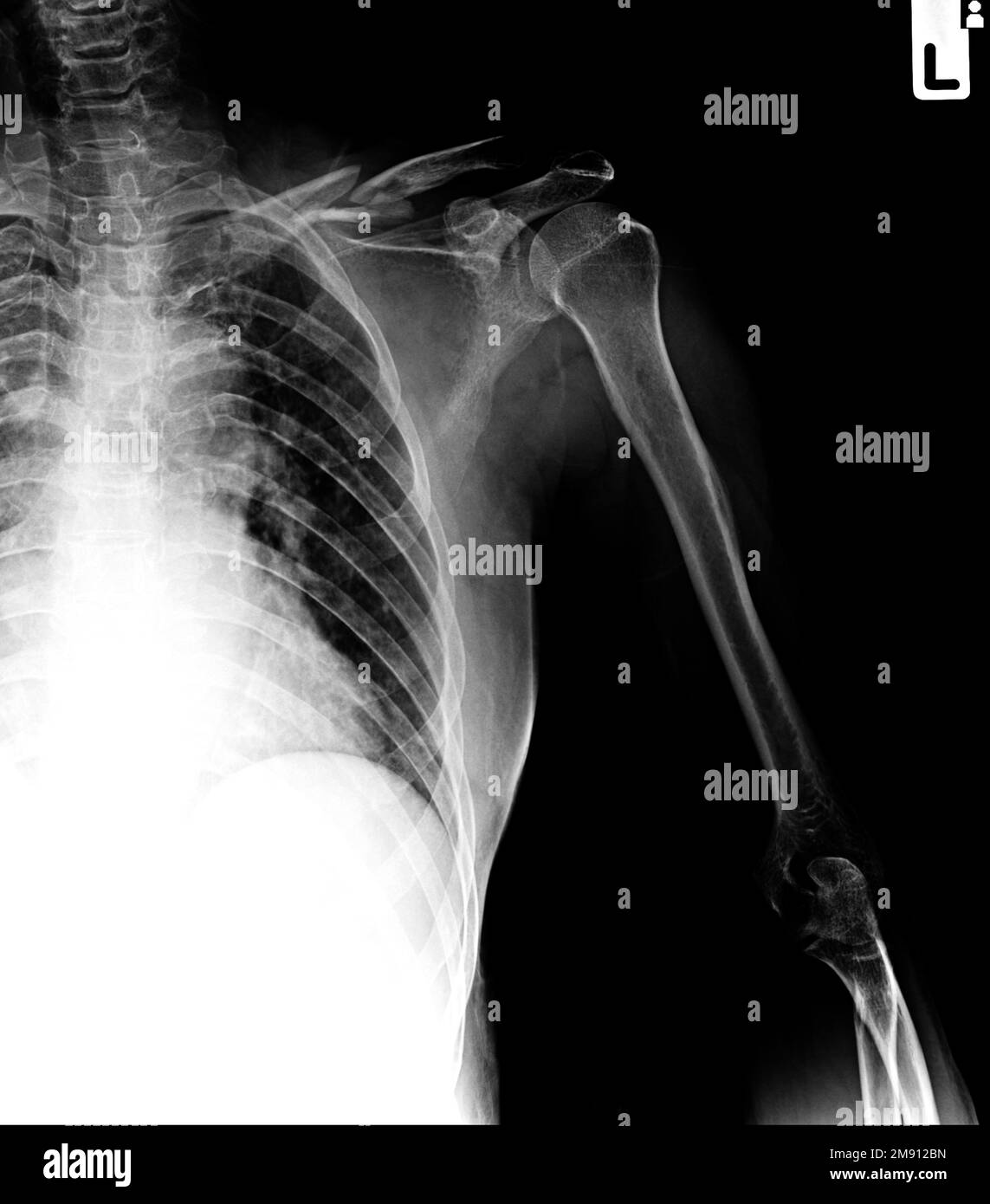Film x-ray clavicle AP show fracture clavicle bone Stock Photo