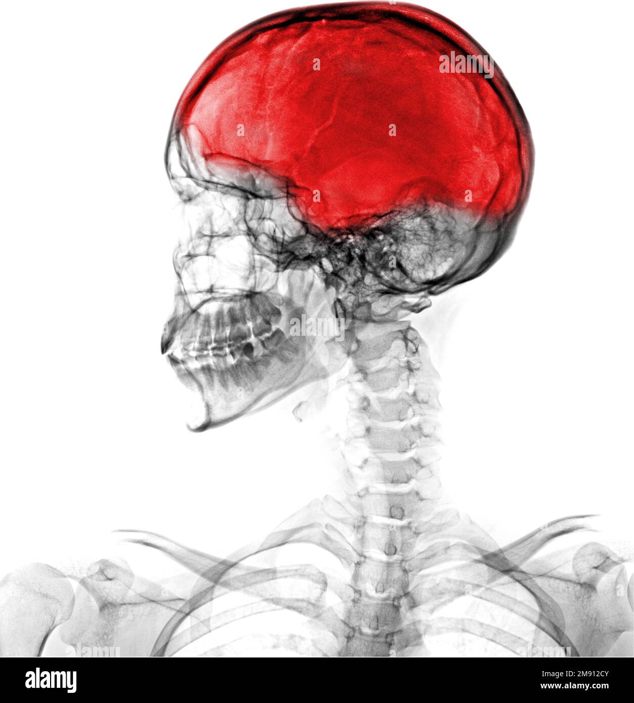 X-ray skull lateral view show head injury Stock Photo