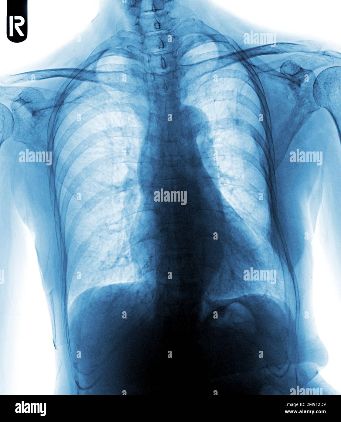 Film chest x-ray show interstitial infiltration both lung Stock Photo ...