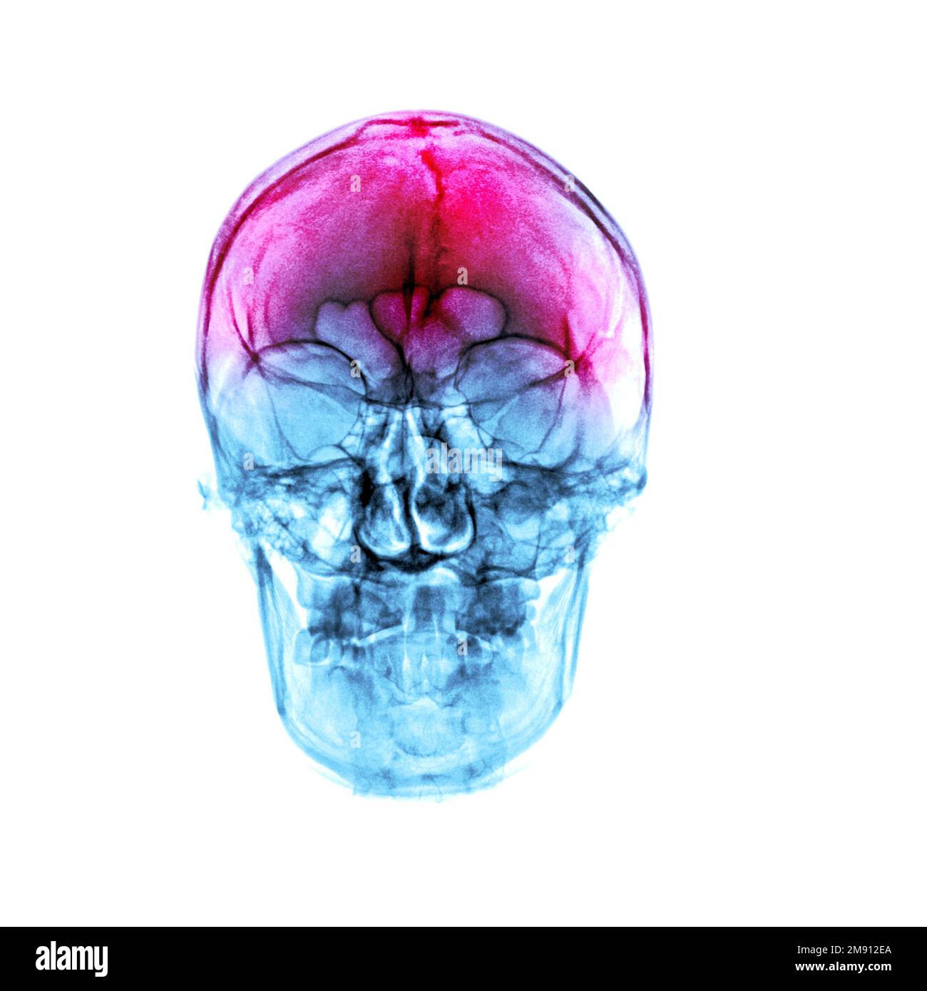 Headache of trauma. Film x-ray human skull . front view . Stock Photo