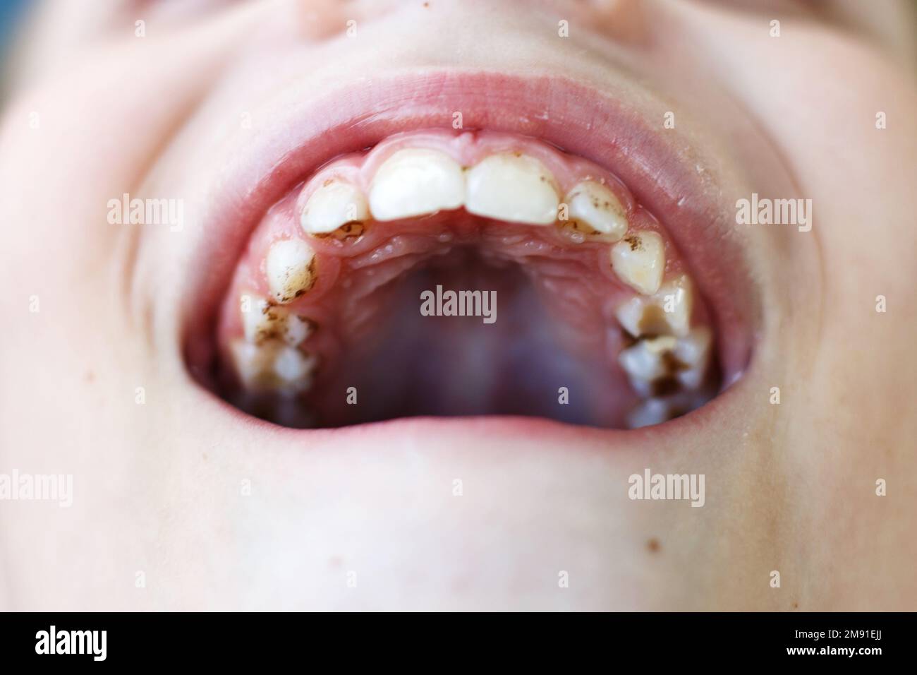 open mouth of a child boy with plaque or calculus on the teeth close. oral hygiene concept. Stock Photo