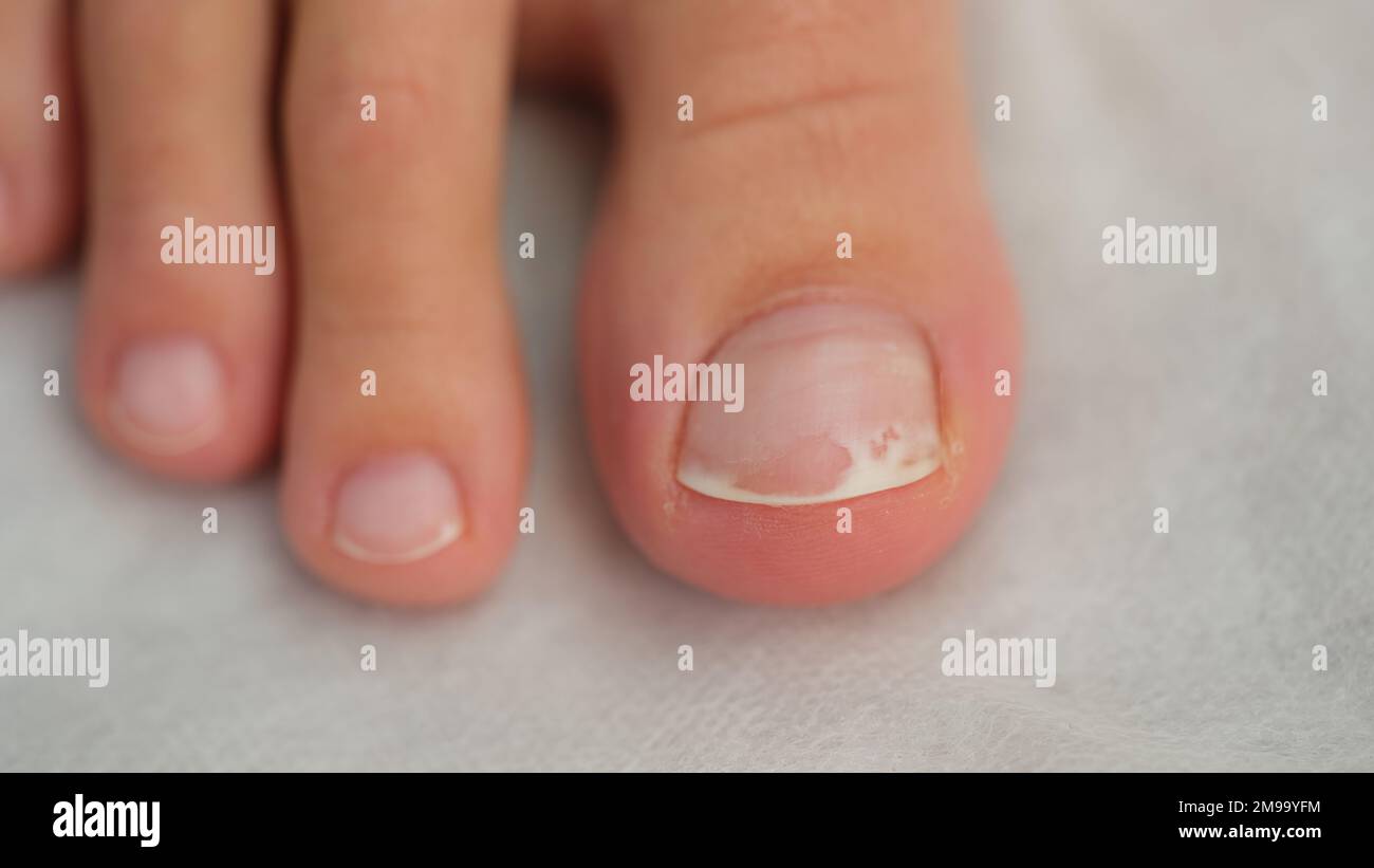 Damaged toenail close up, shallow depth of field. Stock Photo