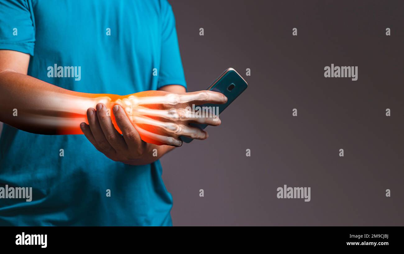 Carpal Tunnel Syndrome (CST)., xray concept Stock Photo Alamy