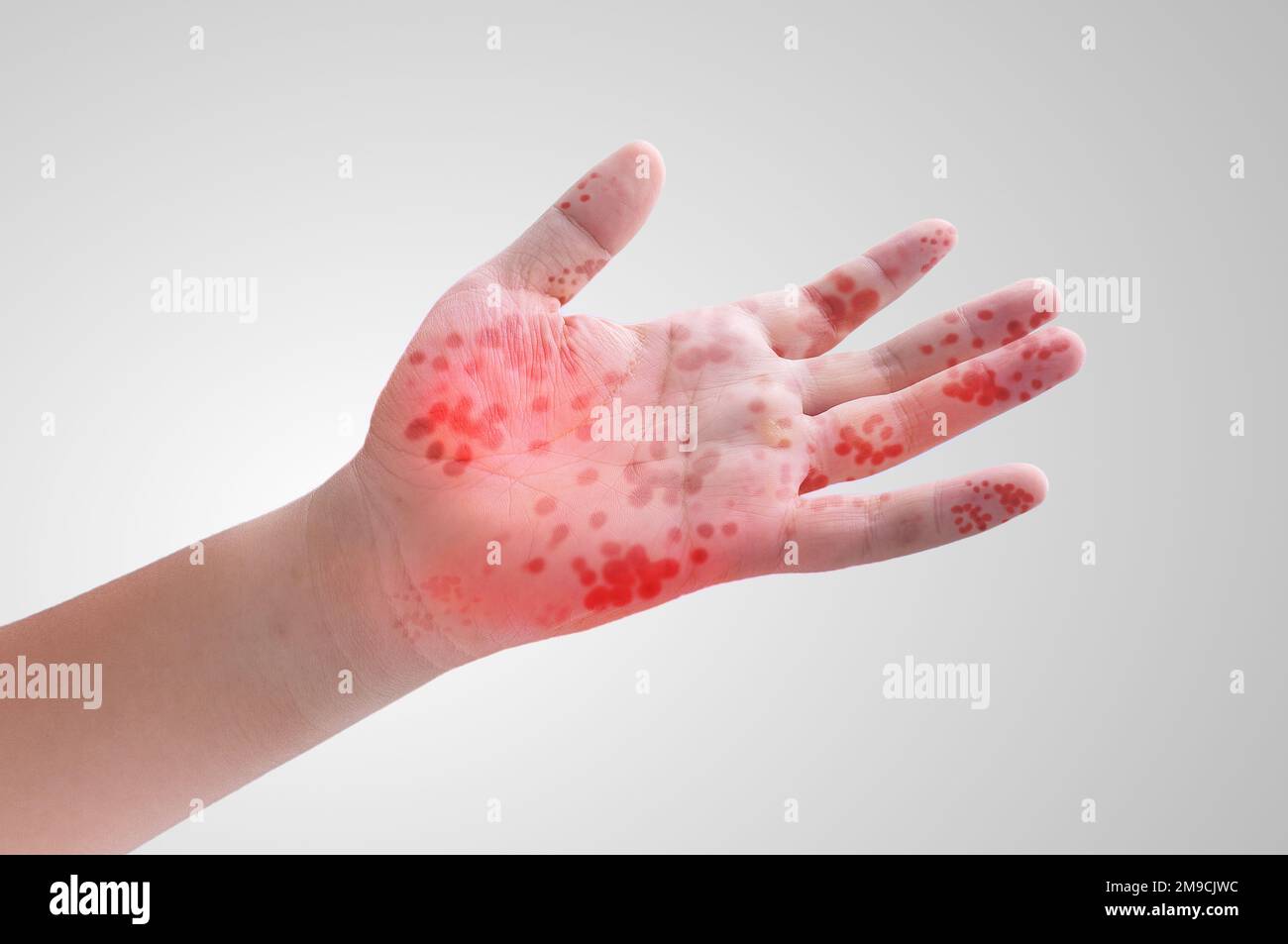 Viral Diseases Hand Infected Hand foot and mouth disease HFMD Stock