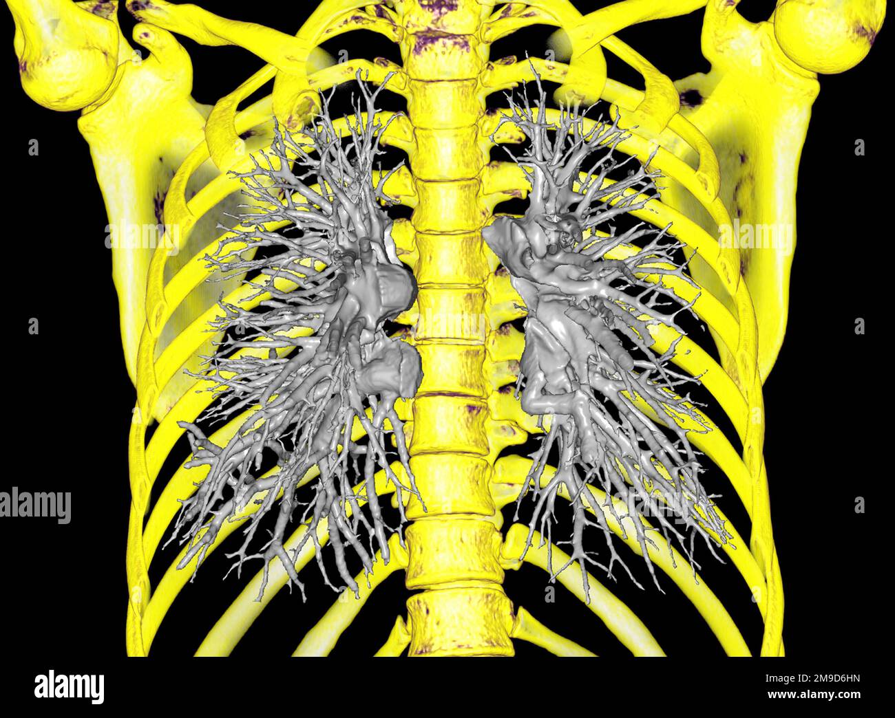 Healthy lungs, CT scan Stock Photo Alamy