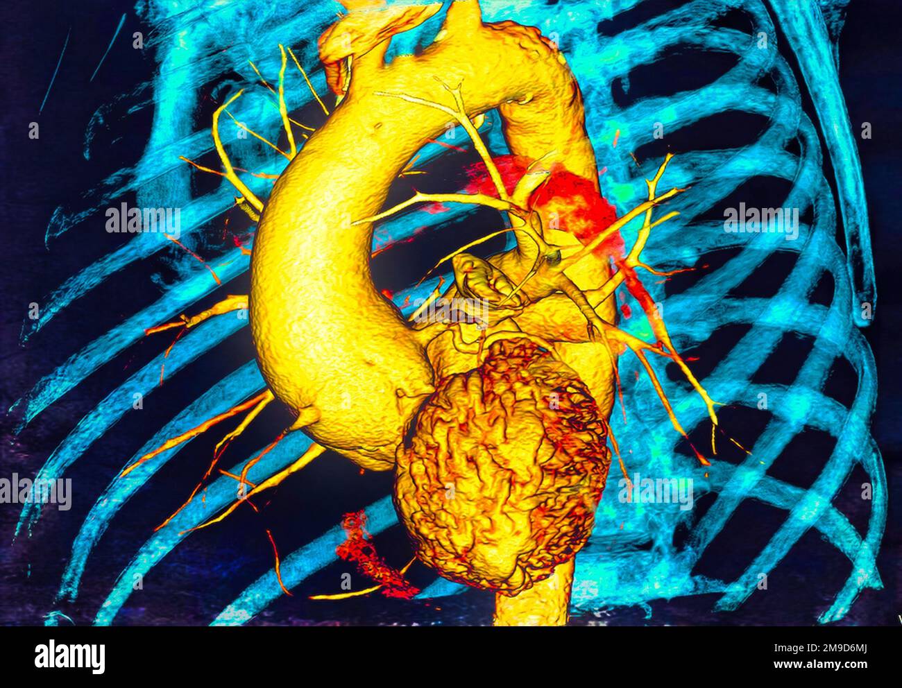 Aortic Aneurysm CT Scan Stock Photo Alamy