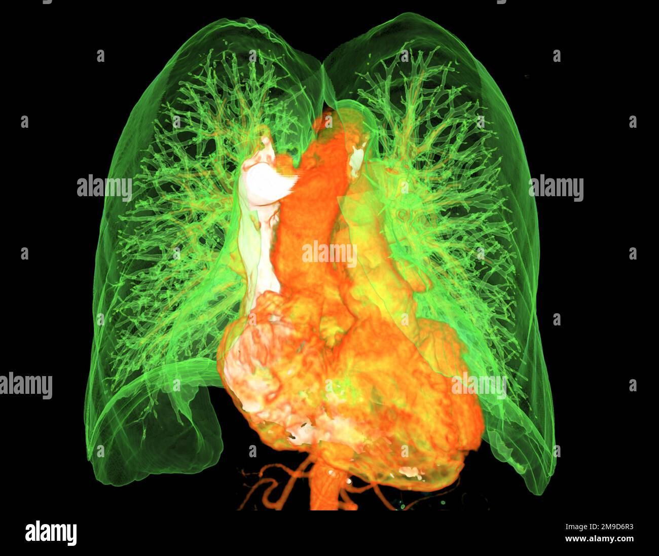 Healthy heart and lungs, CT scan Stock Photo Alamy