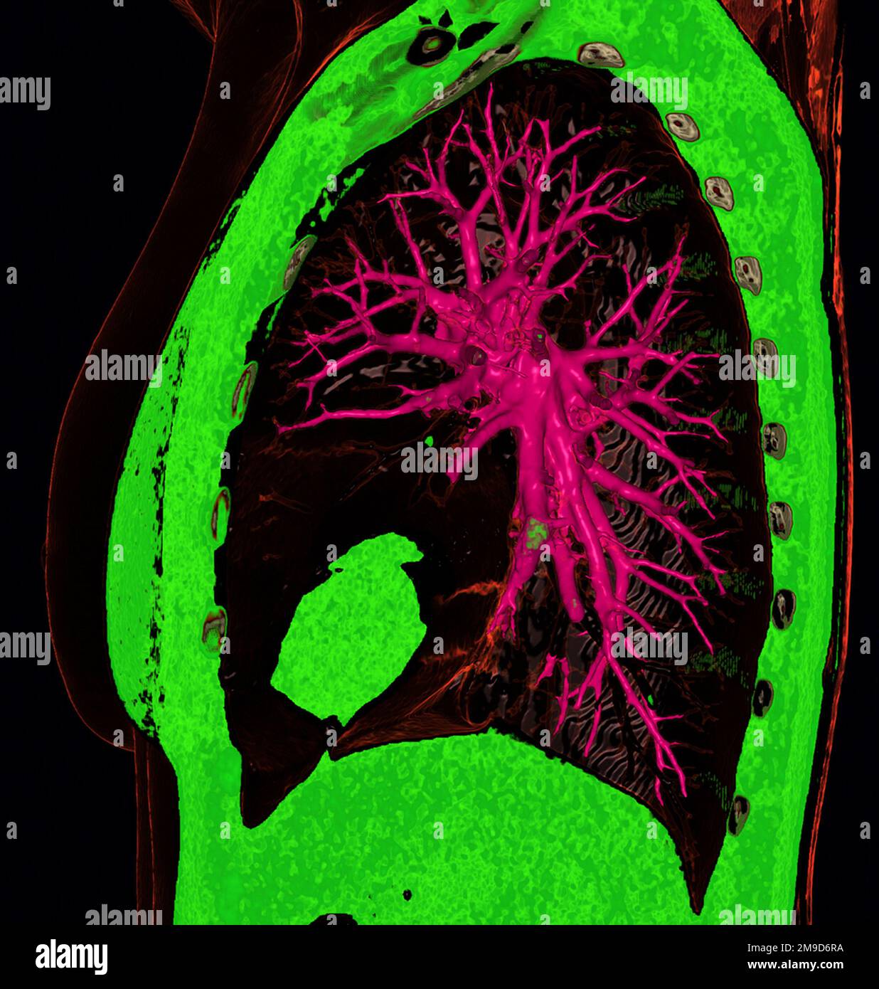 Healthy lung, CT scan Stock Photo Alamy