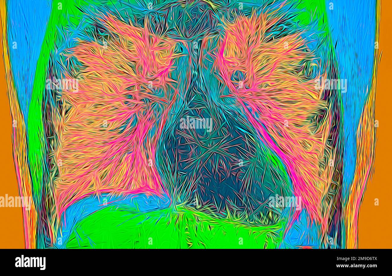 Healthy heart and lungs, CT scan Stock Photo Alamy