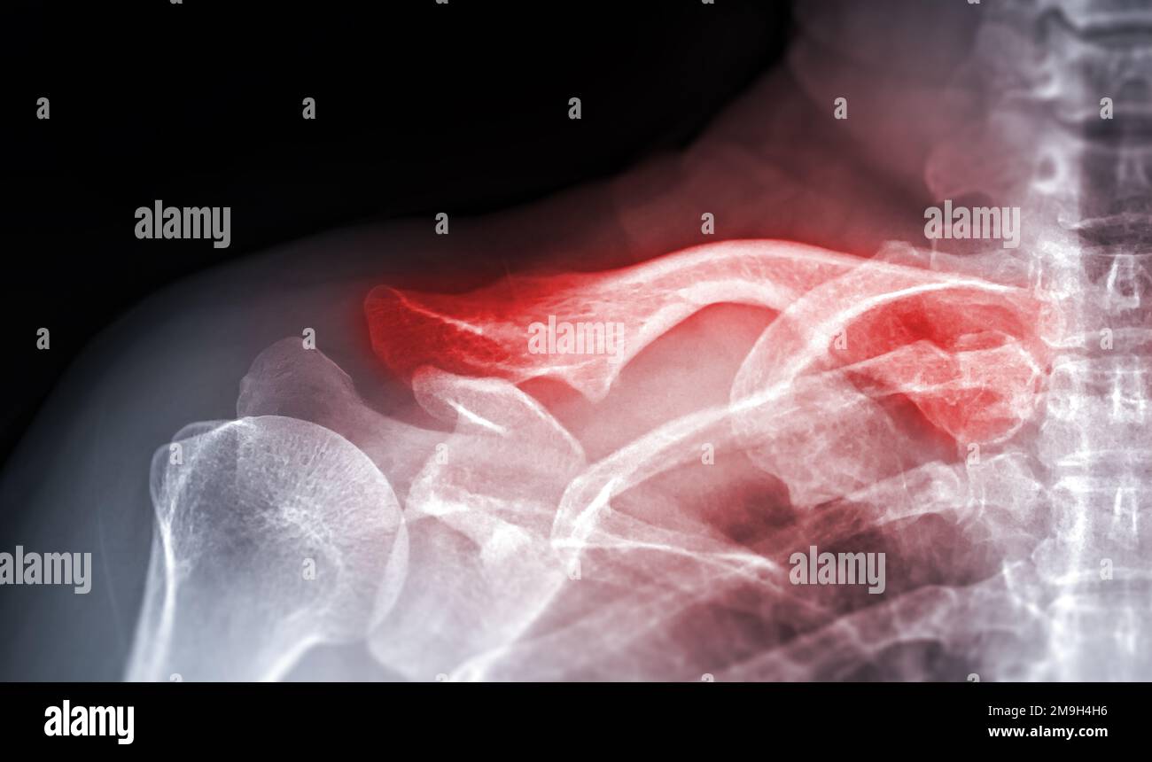 X-ray of Clavicle AP view for diagnosis fracture of Clavicle bone. Stock Photo