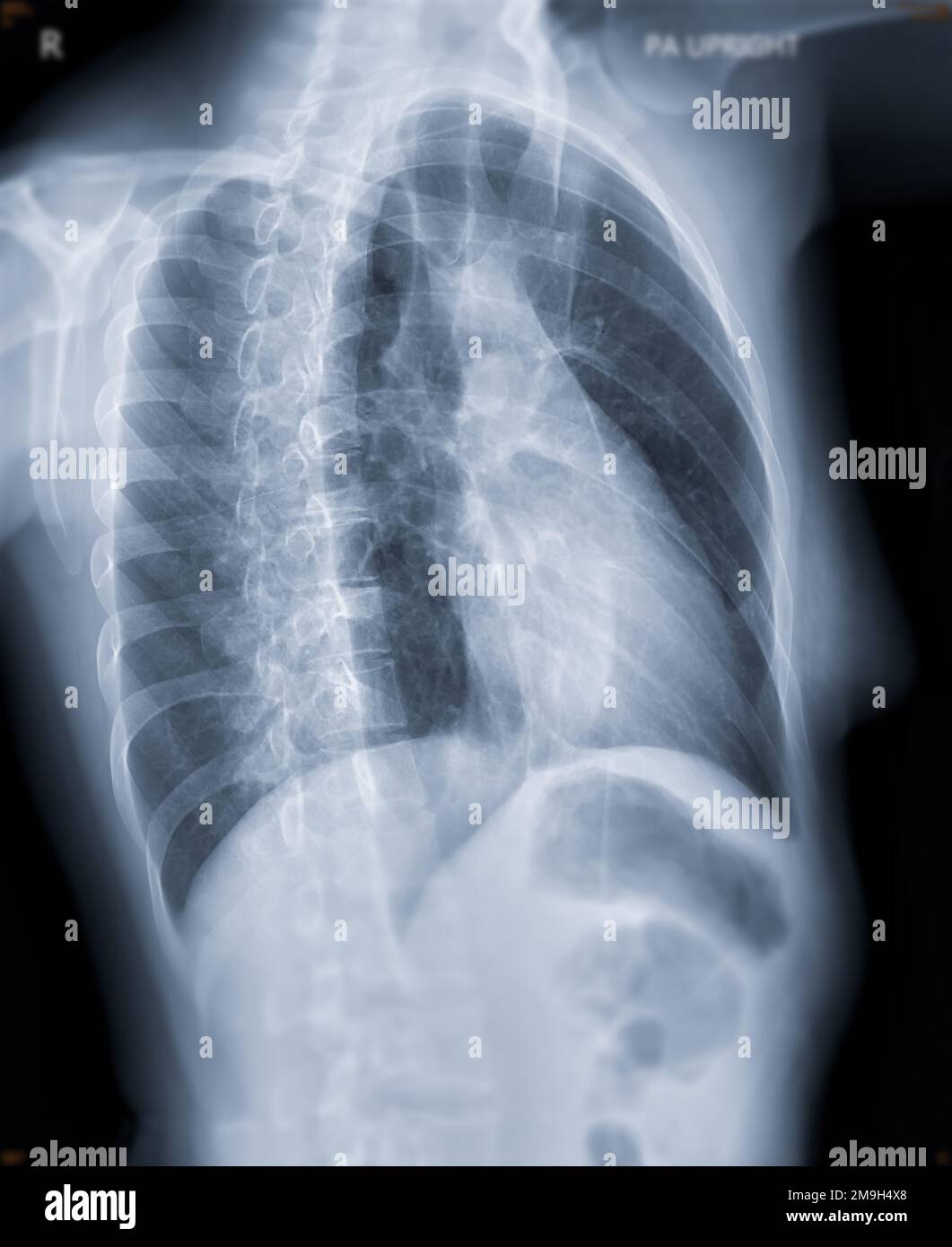 Chest xray image oblique view for screening diagnosis TB,tuberculosis