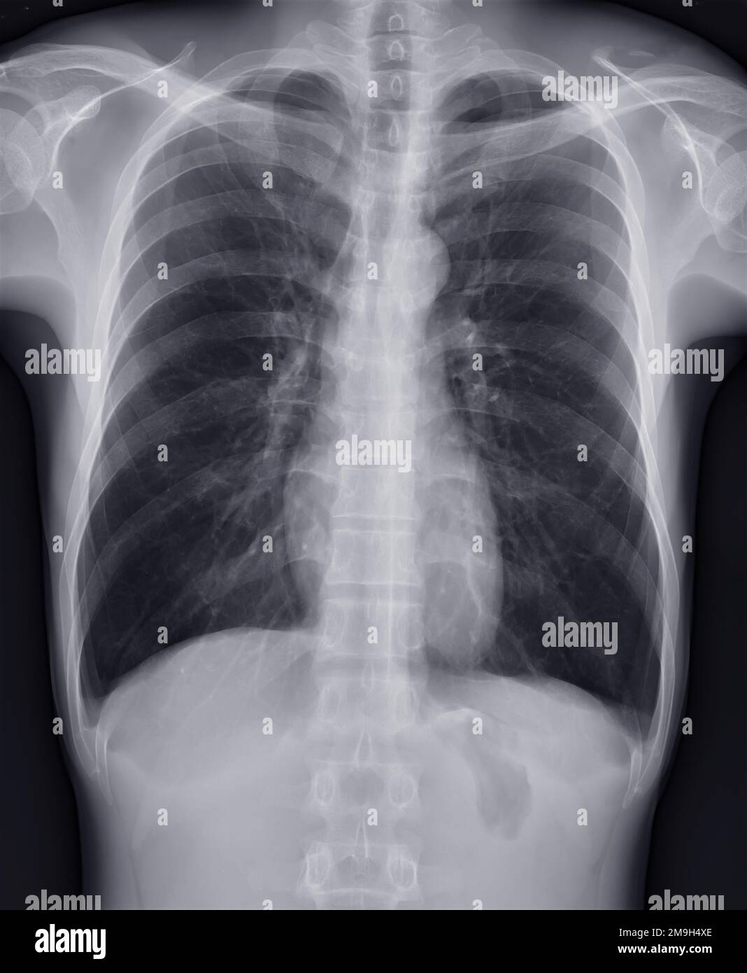 Chest xray image for screening diagnosis TB,tuberculosis and covid19