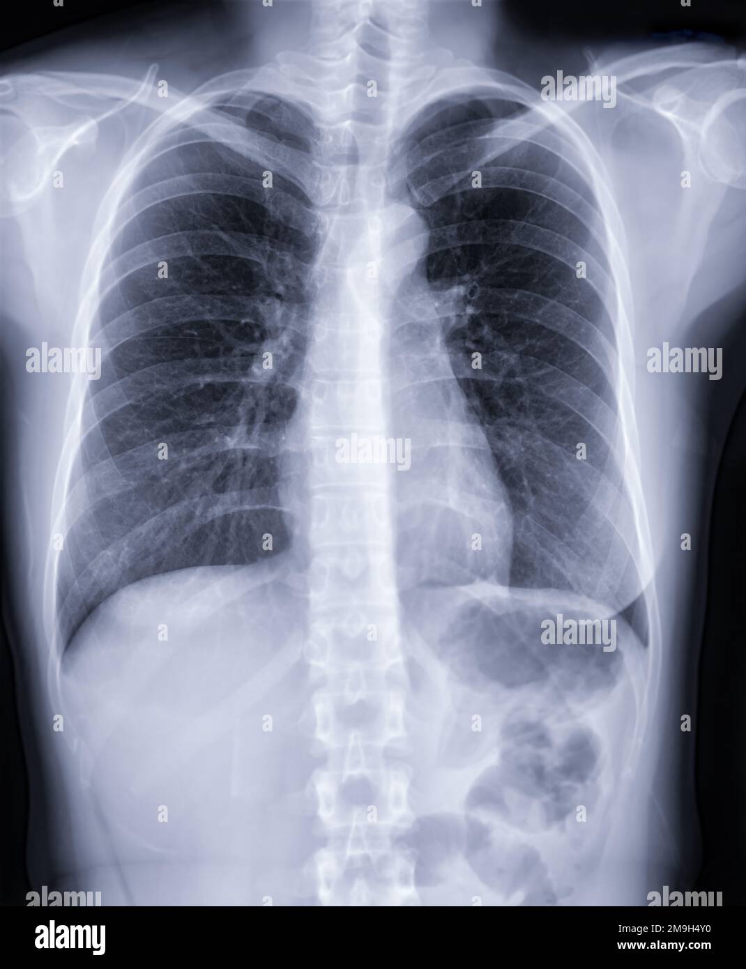 Icd 9 tb screening