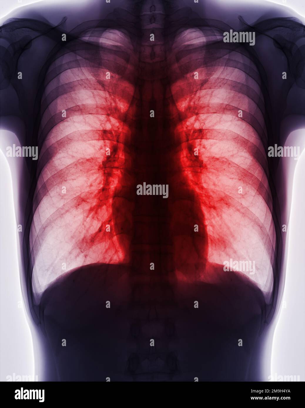 Chest xray image for screening diagnosis TB,tuberculosis and covid19