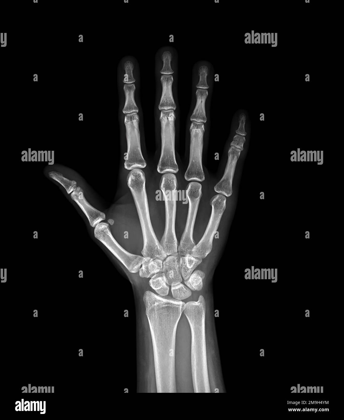 xray image of both hand AP view isolated on black background for