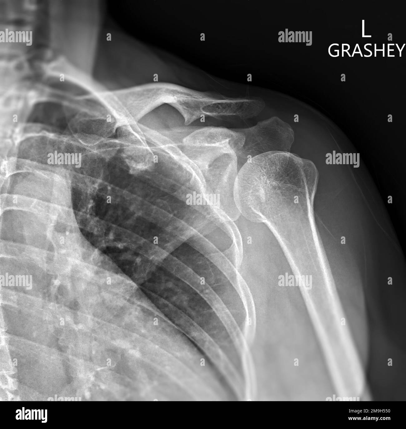 Xray of Shoulder joint Grashey view for diagnosis shoulder joint from