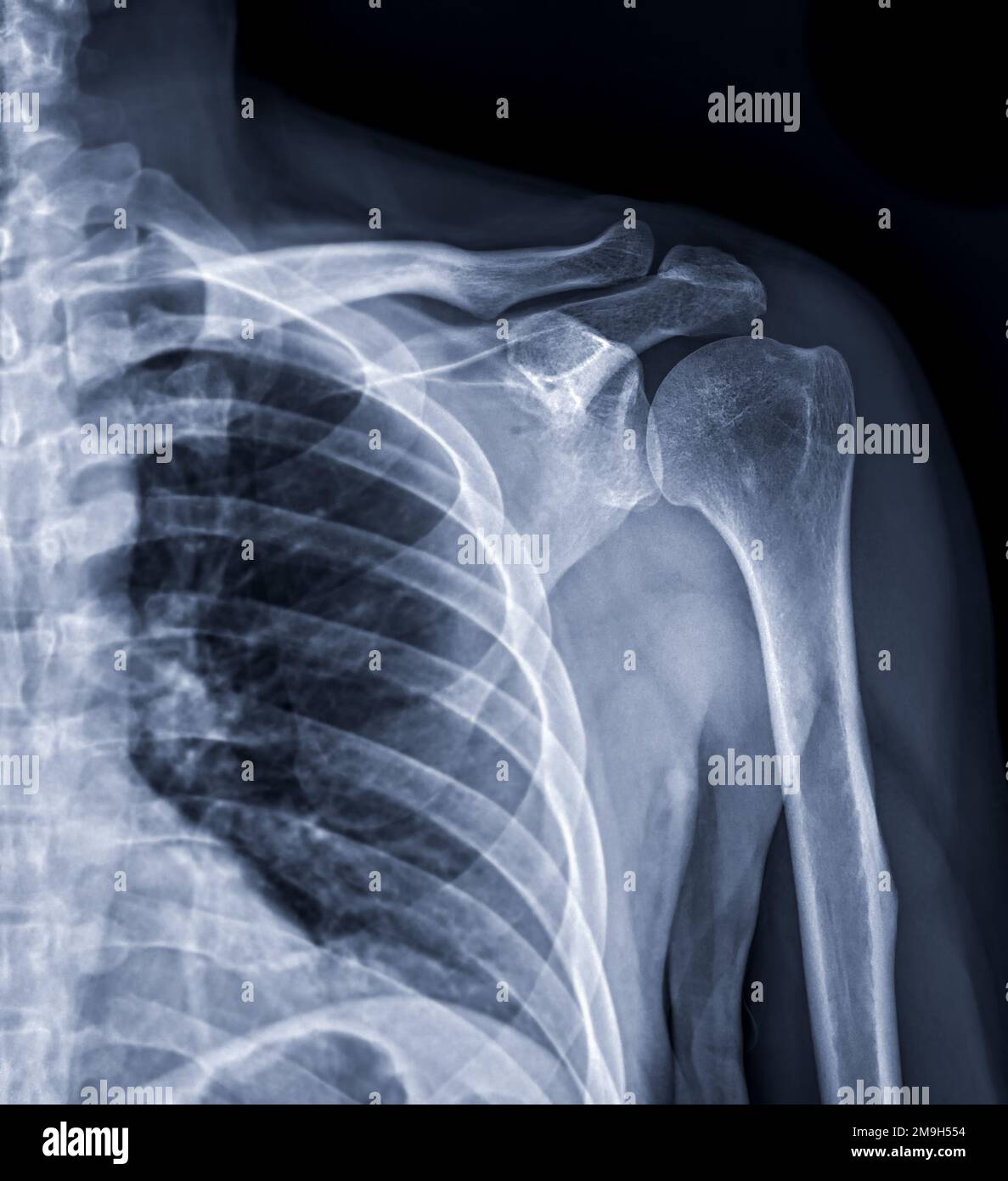 Xray of Shoulder joint for diagnosis shoulder joint from dislocation
