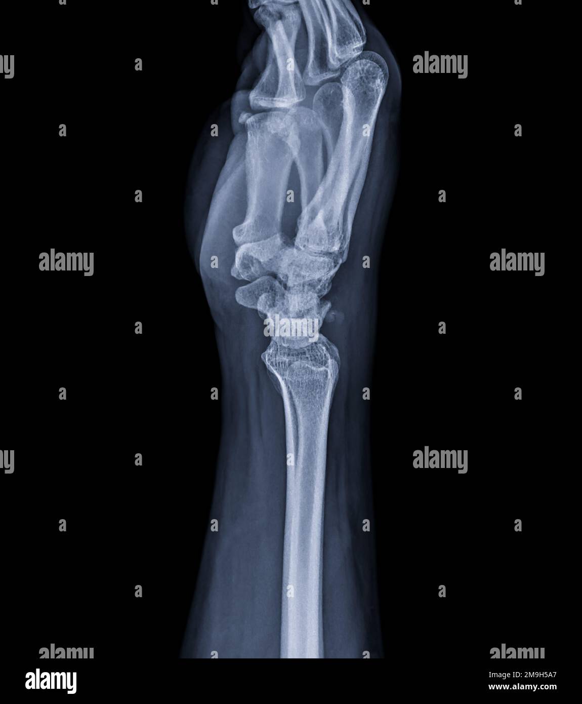 Xray image of wrist joint for diagnosis rheumatoid arthritis Stock